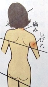 首の痛みと腕の痺れ